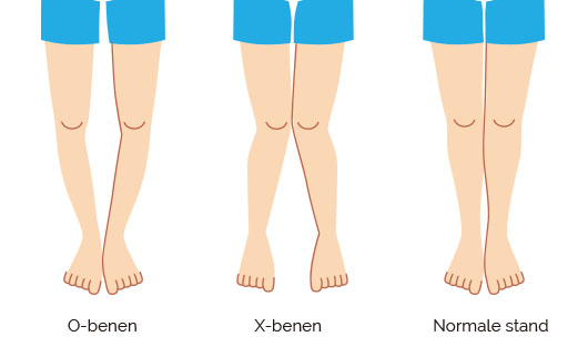 Bow legs